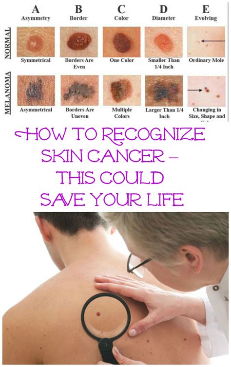 difference between age spots and skin cancer